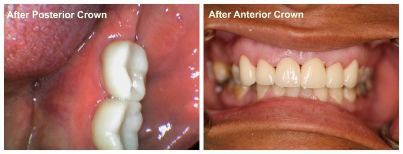 after posterior anterior crown