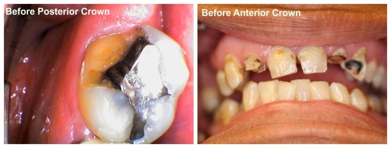 (left — Before Posterior Crown): Mandibular first molar with large amalgam restoration, recurrent caries, and marginal breakdown — pre-crown. (right — Before Anterior Crown): Maxillary central incisor with fractured enamel, discoloration, and old composite restoration — pre-crown.