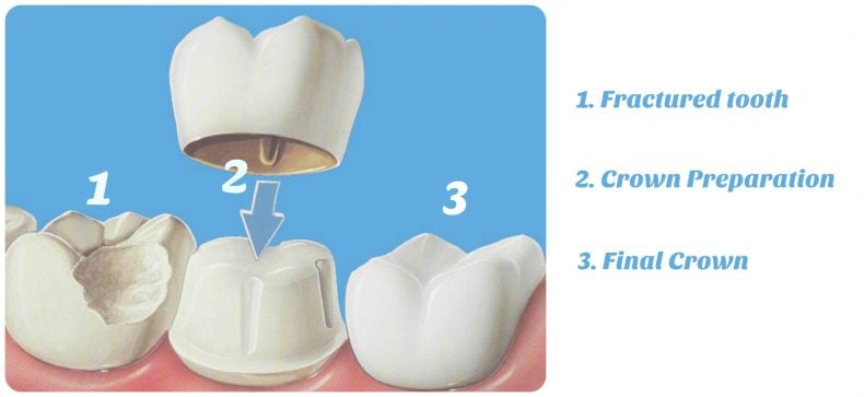 crown preparation final