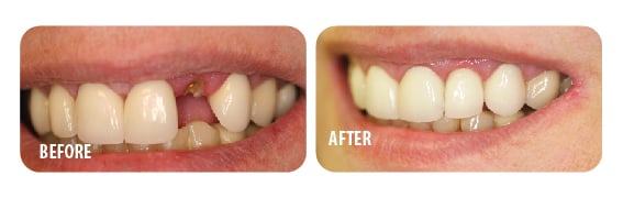 dental implants before and after