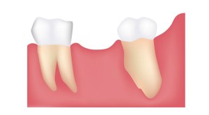 illustration of a missing teeth