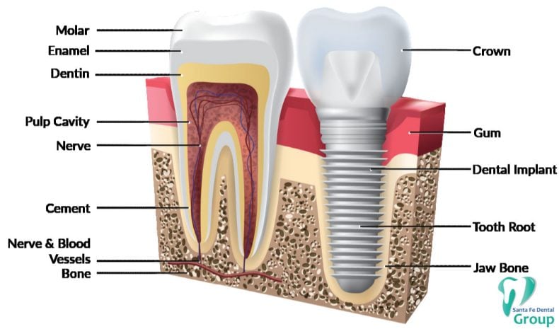 Tooth VS IMPLANT