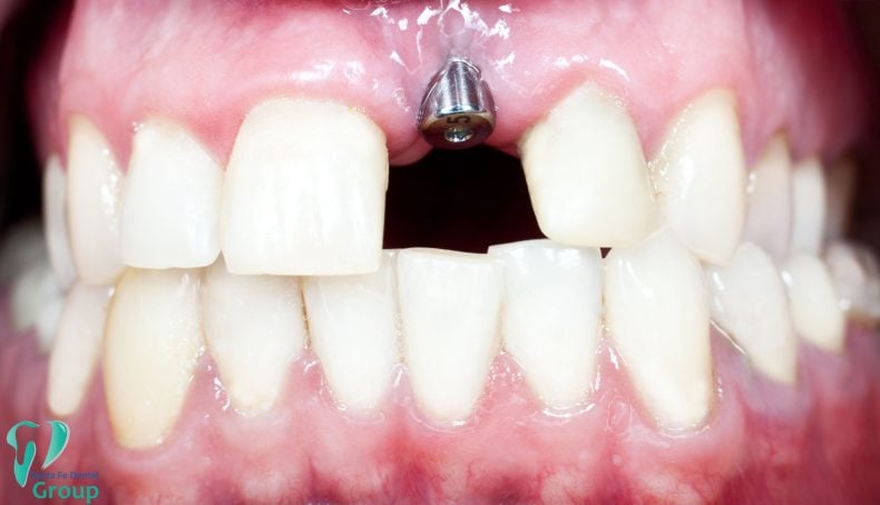 dental implants