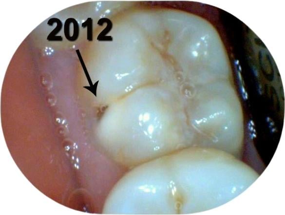 Toothache progression from a cavity or infect tooth