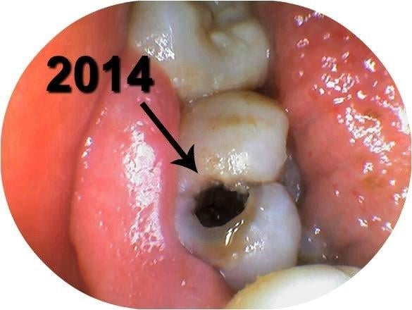Toothache progression from a cavity or infect tooth