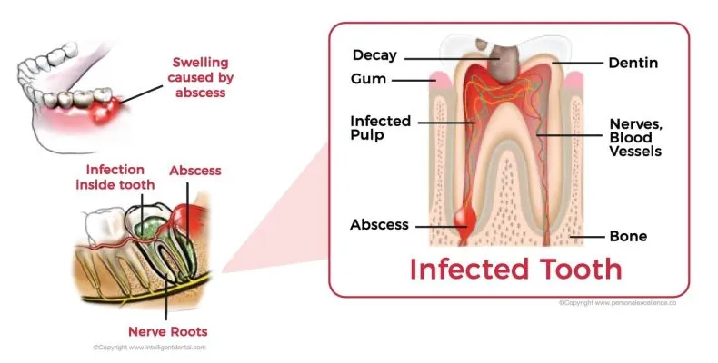 infected tooth illustration