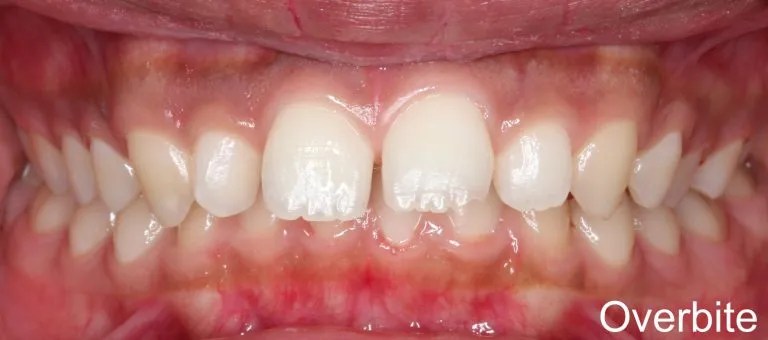 Post-orthodontic alignment: significantly improved tooth positioning, reduced crowding, and harmonious occlusion