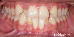 Severe anterior crowding: upper and lower incisors overlapping and rotated