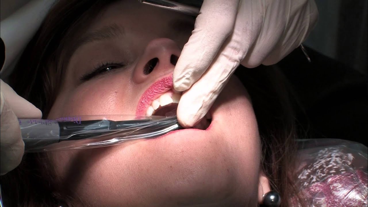 Tooth Bonding Video Thumbnail